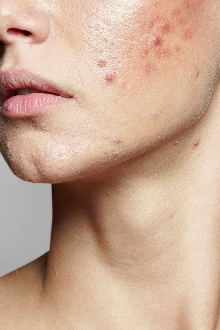 Acne & Oily Skin